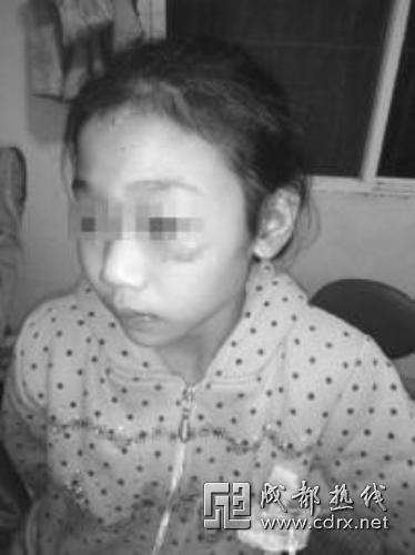 江油11岁女孩伤痕满身称被刀割针扎虐待 警方刑拘养父母